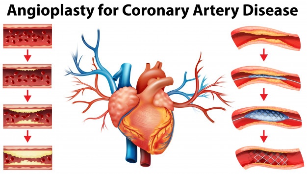 Coronary Artery