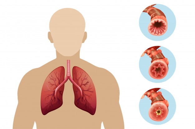 lung diseases